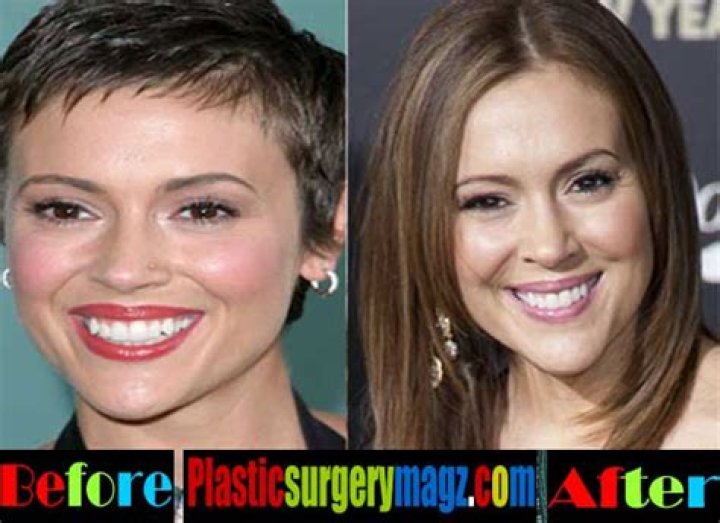 Alyssa Milano Plastic Surgery Before and After