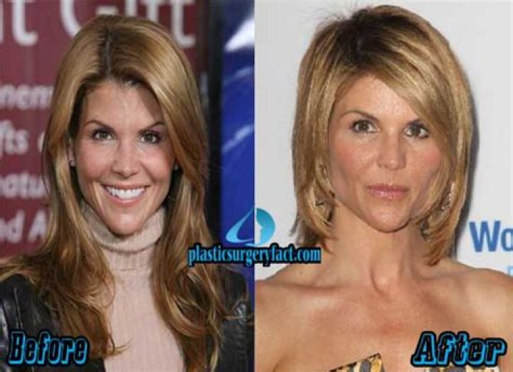 Lori Loughlin Plastic Surgery Before and After